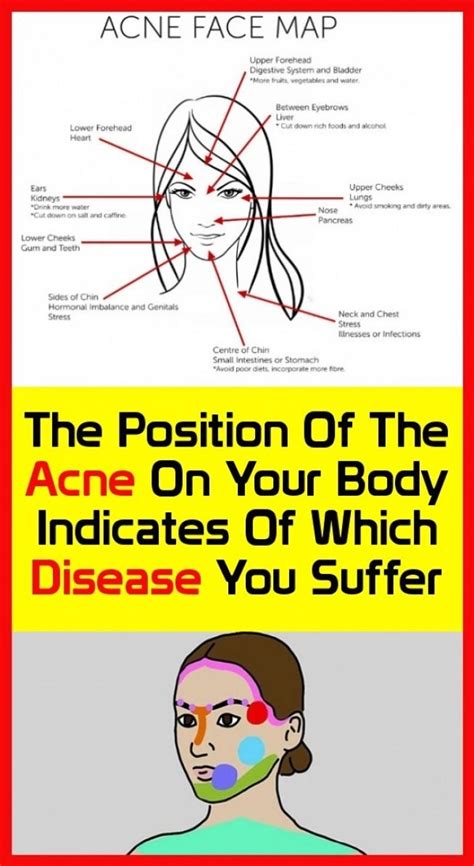 The Position Of Acne On Your Body Shows Which Conditions You Suffer