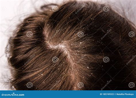 Dandruff Seborrhea Problem Of Scalp And Hair Treatment Of Peeling From