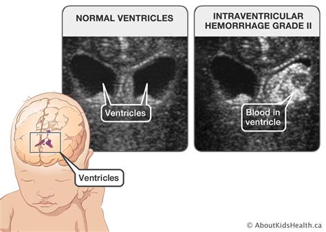 Diagnosis Of Intraventricular Hemorrhage Ivh In Premature Babies