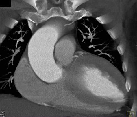 Extensive Aortic Valve Calcification With Aortic Stenosis And Dilated