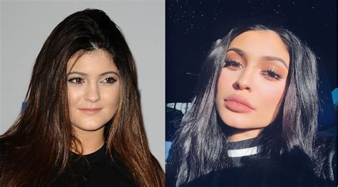 kylie jenner opens up about plastic surgery and reveals the real reason she gets lip fillers