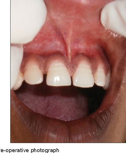 Figure 1 From Surgical Management Of Aberrant Labial Frenum Using Modified Z Frenuloplasty A