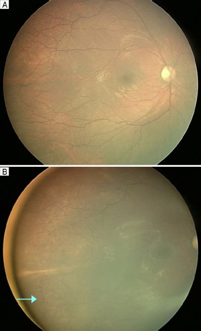 Fundus Photographs Of The Right Eye Of Patient 2 At Presentation A