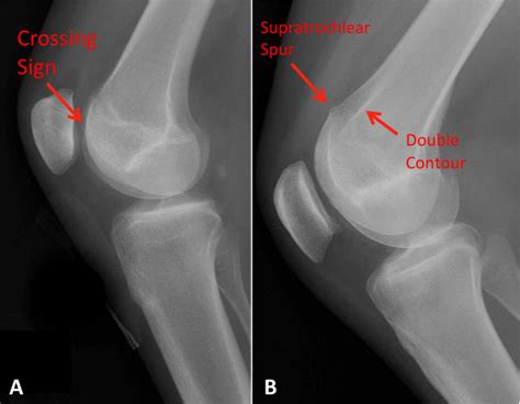 Trochlear Dysplasia Knee Pain Colorado Knee Specialist