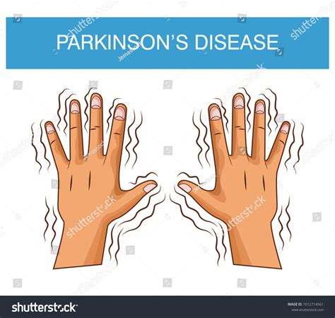 Parkinsons Disease Cartoon Stock Vector Royalty Free 1012714561