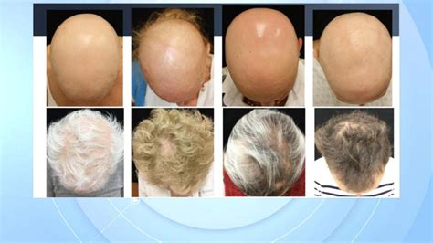 Fda Approves Use Of Olumiant To Help Treat Severe Alopecia Areata Good Morning America