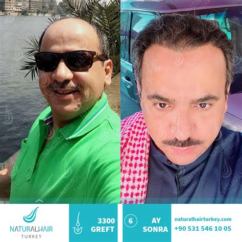 Sachane.com sitesinde ihtiyaç duyduğunuz bütün profesyonel saç bakım ürünleri, şekillendiriciler, boya bakım ürünleri, kişisel bakım ürünleri, profesyonel ekipmanlar, dermokozmetik ürünleri, anne & bebek ürünleri, erkek bakım ürünleri, besin & destek ürünlerinin yanı sıra, piyasanın en uygun fiyatlarının bulunduğu fırsatlar ve diğer tüm kampanyalar sizlerin. Saç Ekimi Öncesi ve Sonrası - Natural Hair Turkey