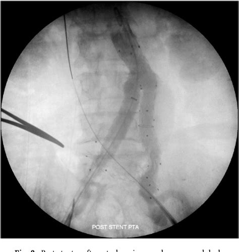 Figure 3 From Endovascular Management Of Aortocaval Fistula