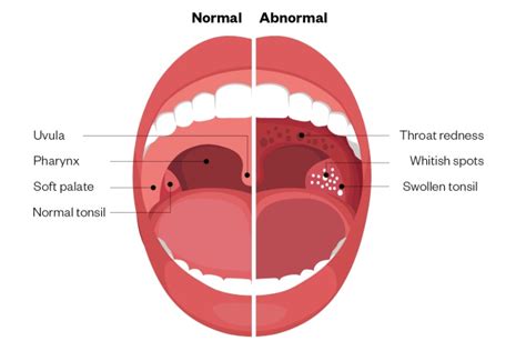Swollen Tonsils Throat