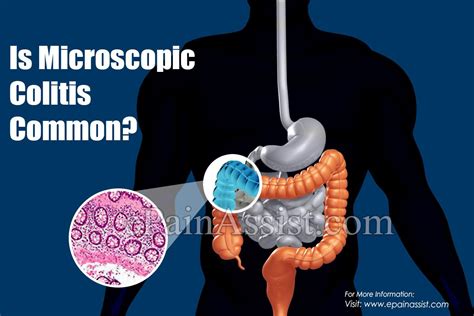 Is Microscopic Colitis Common With Images Microscopic Colitis