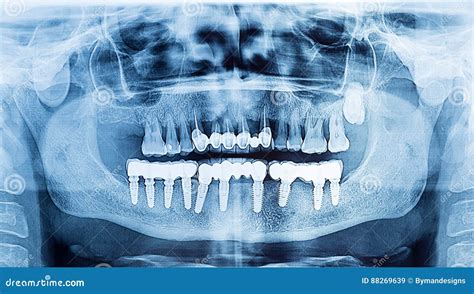 Dental X Ray Panoramic Of Upper And Lower Jawdental Implant Pro Stock