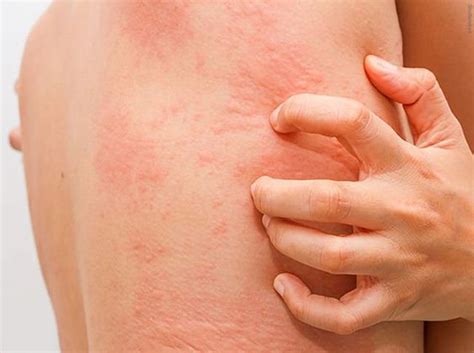 Causes Of Red Spots On Skin That Itch Health Wellness Blog