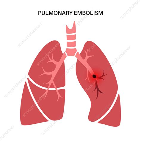 Pulmonary Embolism Illustration Stock Image F0366484 Science