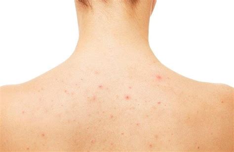 Easy And Effective Home Remedies To Treat Back Acne Scars