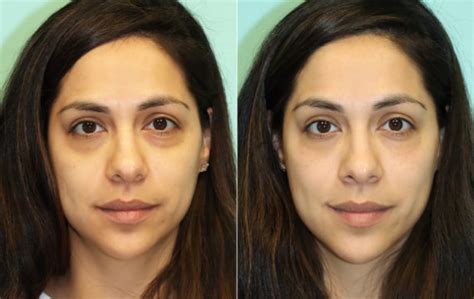 Tear Trough Under Eye Injections Before And After Photos The Naderi Center For Plastic