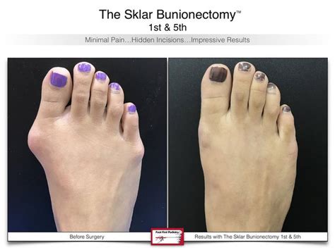 Bunion Podiatry Bunion Surgery