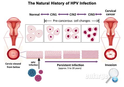 Hpv Self Sampling