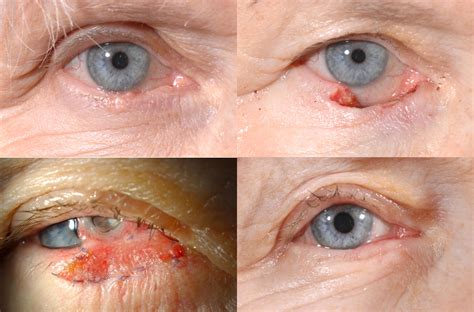Basal Cell Carcinoma Eyelid Rodent Ulcer