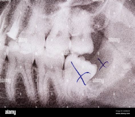 X Ray Picture Of Teeth Removal Of Wisdom Tooth And Dental Inflamed