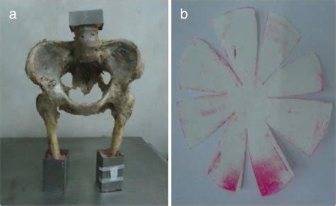 The Biomechanical Differences Of Rotational Acetabular Osteotomy