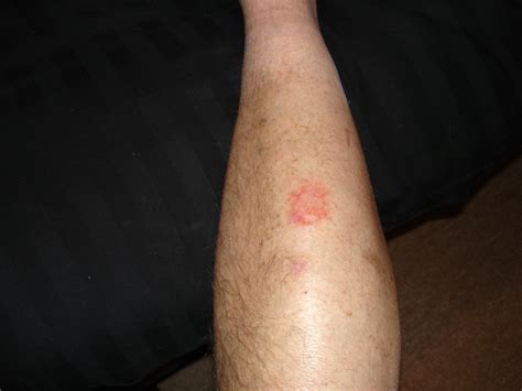 I Dont Know If Its A Fungus Or What Lower Legshins Rash