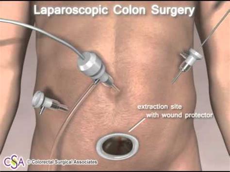 Laparoscopic Colon Surgery Colorectal Surgical Associates YouTube