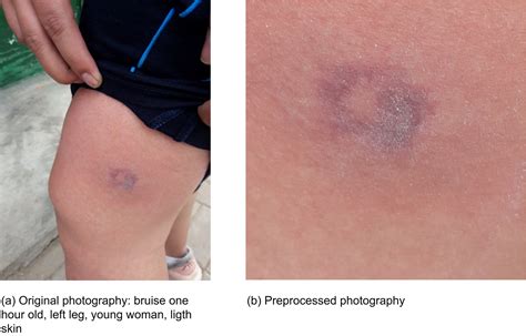 Bruise Dating Using Deep Learning Tirado 2021 Journal Of Forensic Sciences Wiley Online