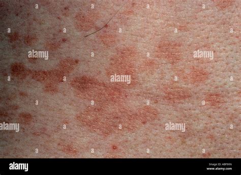 The Rash Of Pityriasis Rosea Due To The Human Herpes Virus 7 Hhv7