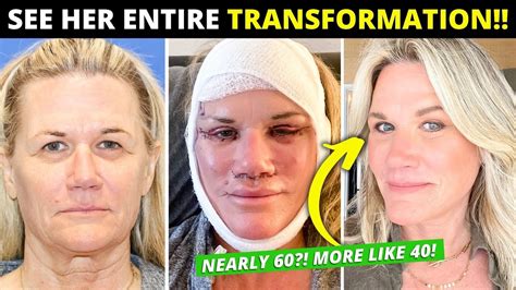 Facelift At Nearly 60 Changes Her Entire Life Dramatic Vertical