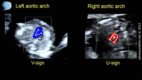 最高 Right Sided Right Aortic Arch Echo がじゃなたろう