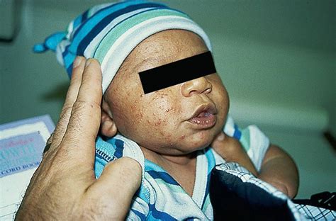 Newborn Skin Abnormalities Visual Diagnosis And Treatment In