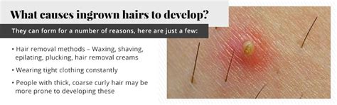 Best Hair Removal For Ingrown Hair Prone Skin How To Get Rid Of Ingrown Hairs Full Guide