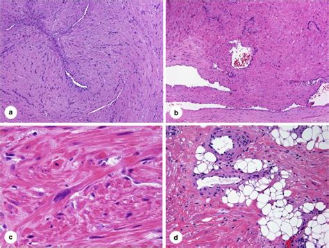 Smooth Muscle Tumors Of Soft Tissue And Non Uterine Viscera Biology