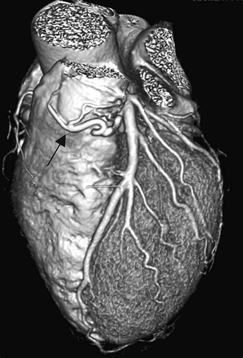 Coronary Pulmonary Fistula Emergency Medicine Journal