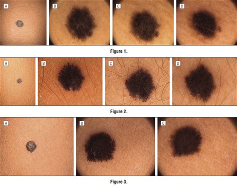 Evolution Of Reed Nevi Dermoscopic Pattern In Childhood Dermatology