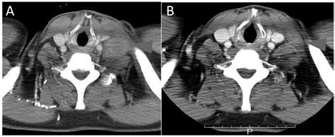 Virchow Lymph Node Metastatic Recurrence Of Sigmoid Colon Cancer With