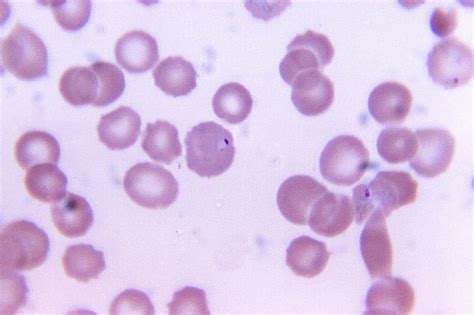 Free Picture Blood Smear Micrograph Plasmodium Falciparum Parasite