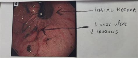 View allall photos tagged hiatalhernia. Large sliding Hiatal hernia leading to anemia - Dr. Adi Malhotra