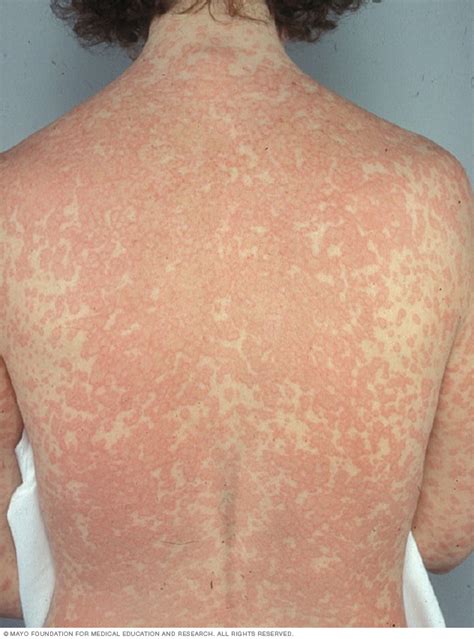 It can occur within seconds or minutes of signs and symptoms include a rapid, weak pulse; Penicillin allergy Disease Reference Guide - Drugs.com
