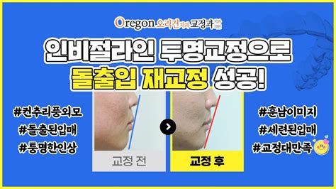 인비절라인 투명교정으로 【돌출입재교정】 성공한 사례 🤍 Feat 치아교정 전문의 Youtube