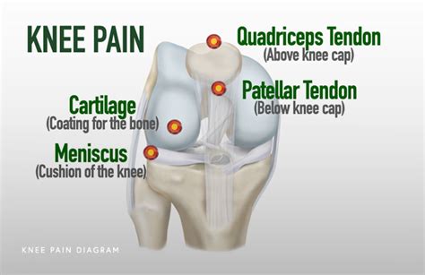 Non Surgical Knee Pain Treatment Chicago Il Dr Jorge Chahla