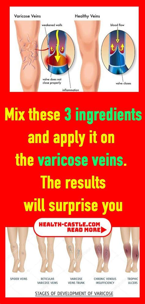 Mix These 3 Ingredients And Apply It On The Varicose Veins The Results
