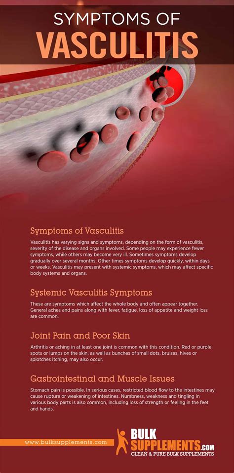 Tablo Read Vasculitis Symptoms Causes And Treatment By