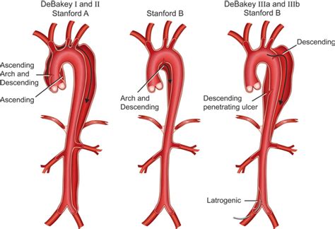 Stanford Types Of Aortic Dissection