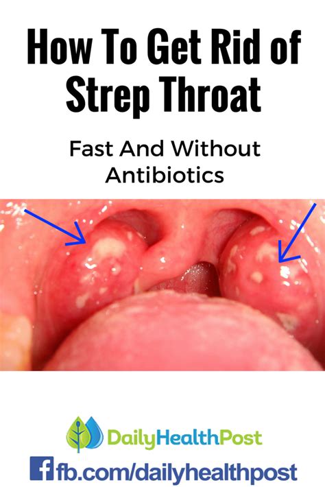 How To Get Rid Of Strep Throat Fast And Without Antibiotics Strep