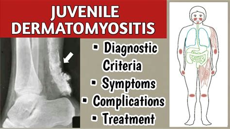 Juvenile Dermatomyositis Symptoms Diagnostic Criteria Complications