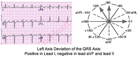 Determine Axis On A 12 Lead Ecg Tracing