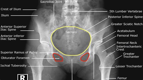 Hip X Ray Interpretation Osce Guide Geeky Medics
