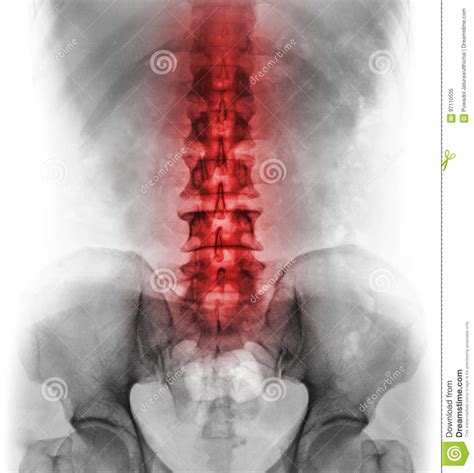 Inflammation Of Lumbosacral Spine Concept Of Vertebral Care Stock