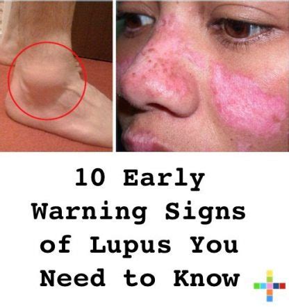 Early Warning Signs Of Lupus You Need To Know Positivemed
